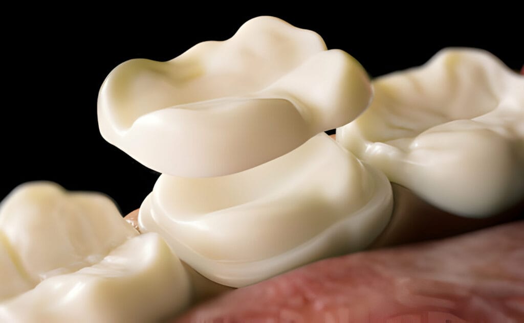Close-up 3D rendering of a dental crown being placed onto a prepared tooth between surrounding molars.